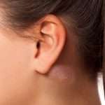 За ушами шишки: причины и лечение