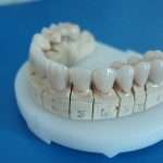 Безметалловая керамика на зубы: особенности, преимущества, технология изготовления, отзывы, фото до и после