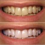 Как сделать зубы белыми в домашних условиях?