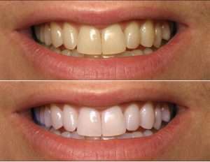 Как сделать зубы белыми в домашних условиях?