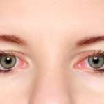 Аллергия на глазах: причины, симптомы, как выглядит, чем лечить