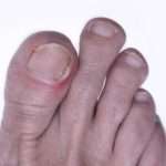 Вросший ноготь на большом пальце: лечение