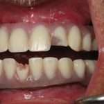 Восстановление зубов: материалы и технологии