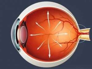 Глаукома глаза: симптомы и лечение